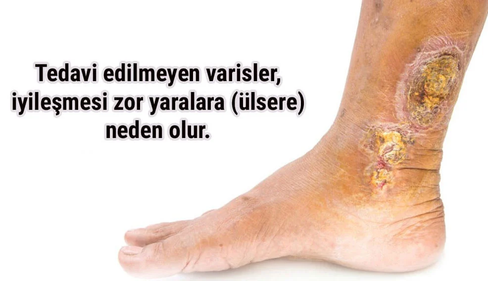 Varis ülseri nedir