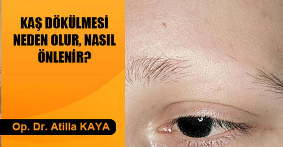 Kaş dökülmesi problemi