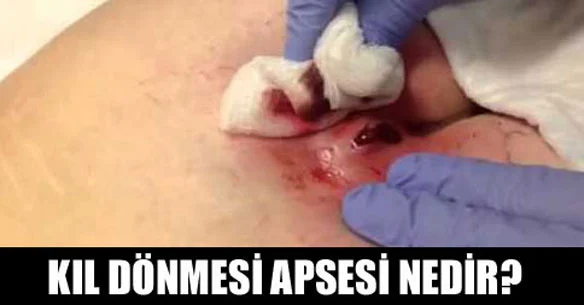 Makatta ağrının nedeni kıl dönmesi apsesi olabilir.