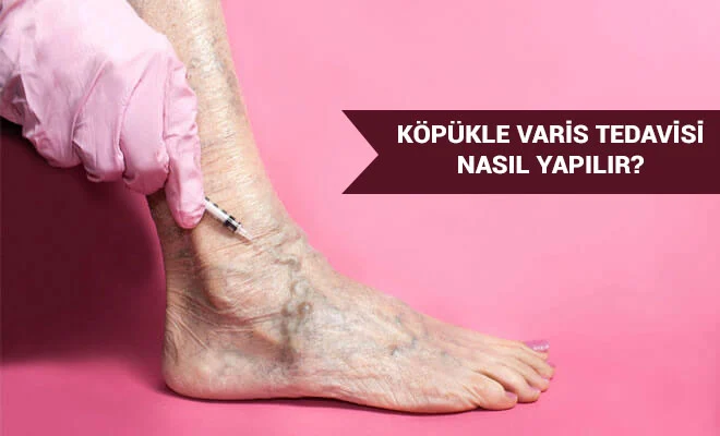 Köpükle varis tedavisi yöntemi