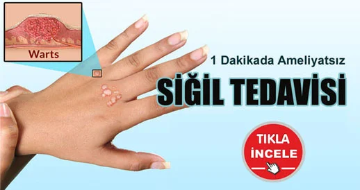 Ameliyatsız siğil tedavisi